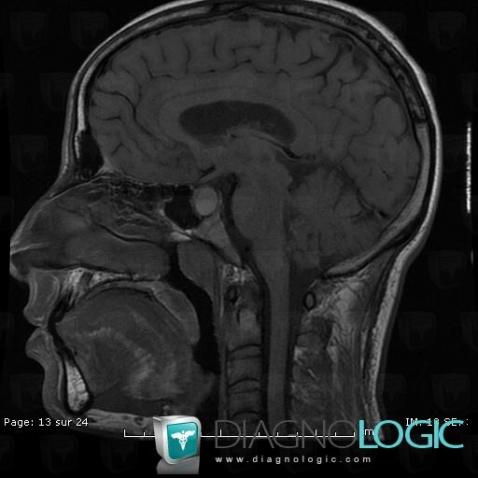 Craniopharyngioma, Cerebral hemispheres, Pituitary gland and parasellar region, MRI