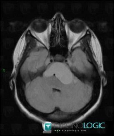 Craniopharyngioma, Infratentorial peri cerebral spaces, Posterior fossa, MRI