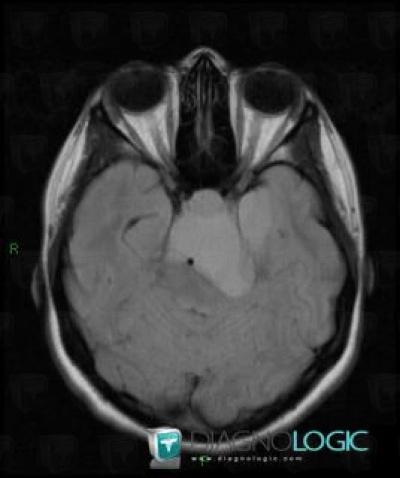 Craniopharyngioma, Pituitary gland and parasellar region, MRI