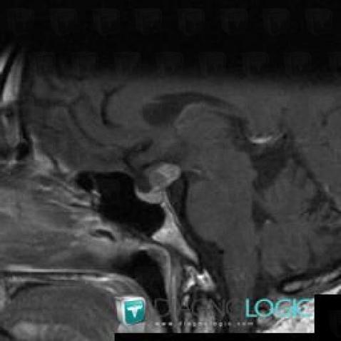 Craniopharyngioma, Pituitary gland and parasellar region, MRI