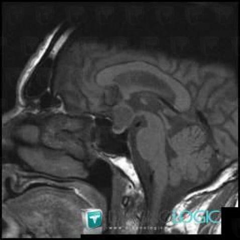 Craniopharyngioma, Pituitary gland and parasellar region, MRI