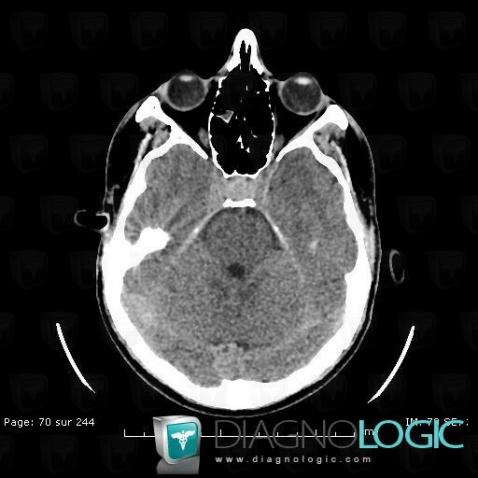 Craniopharyngioma, Supratentorial peri cerebral spaces, Cerebral falx / Midline, CT