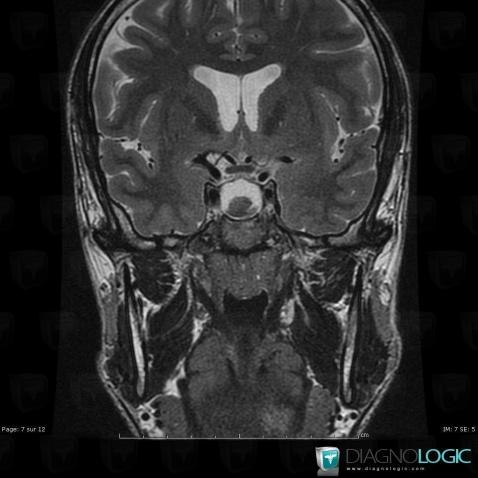 Craniopharyngioma, Supratentorial peri cerebral spaces, Cerebral falx / Midline, MRI