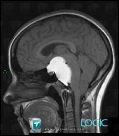 Craniopharyngioma, Supratentorial peri cerebral spaces, Cerebral hemispheres, MRI