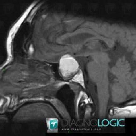Craniopharyngiome, Hypophyse et région parasellaire, IRM