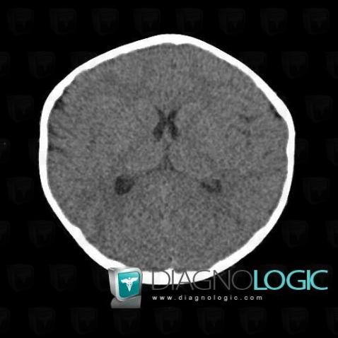 Craniosténose, Voute-crâne, Scanner