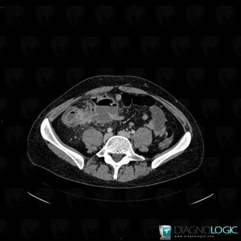 Crohn’s disease, Caecum / Appendix, CT