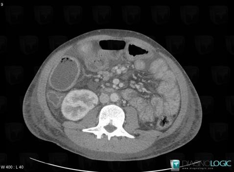 Crohn’s disease, Colon, CT