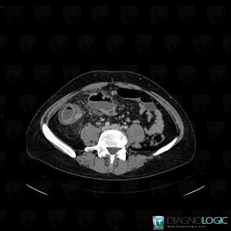 Crohn’s disease, Colon, CT