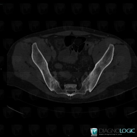 Crohn’s disease, Sacro iliac joint, CT