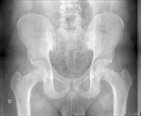 Crohn’s disease, Sacro iliac joint, X rays