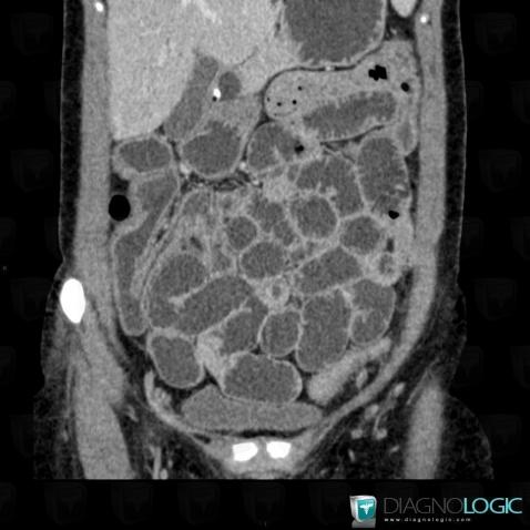 Crohn’s disease, Small bowel, CT