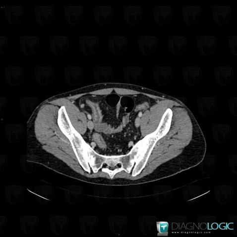 Crohn’s disease, Small bowel, CT