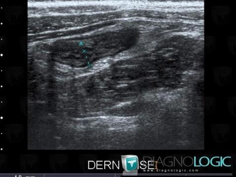 Crohn’s disease, Small bowel, US