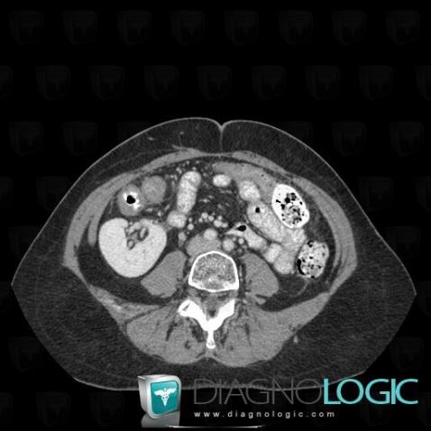 Crossed fused renal ectopia, Kidney, CT