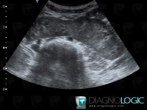 Crossed fused renal ectopia, Kidney, US