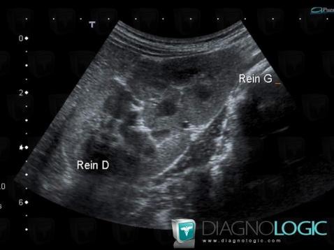 Crossed fused renal ectopia, Kidney, US