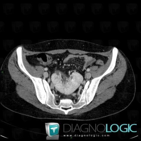 Crossed renal ectopia, Kidney, CT