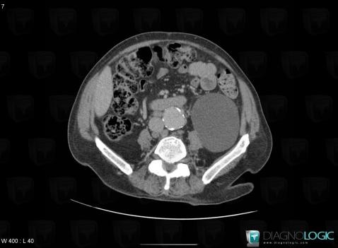 Cyst, Kidney, CT