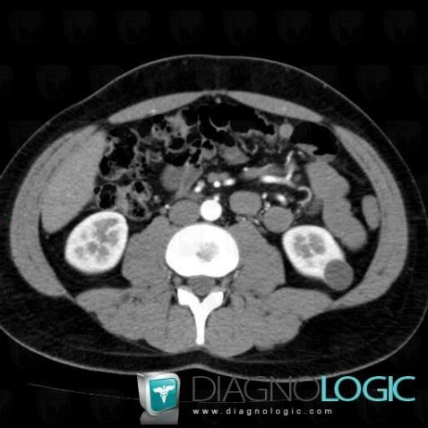 Cyst, Kidney, CT