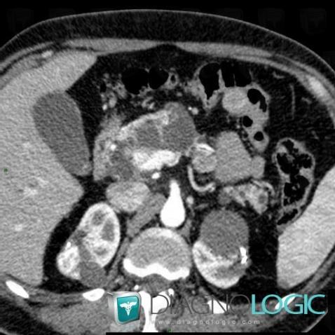 Cyst, Kidney, CT