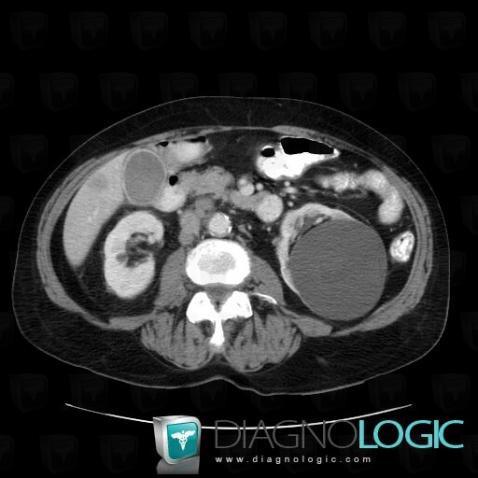 Cyst, Kidney, CT