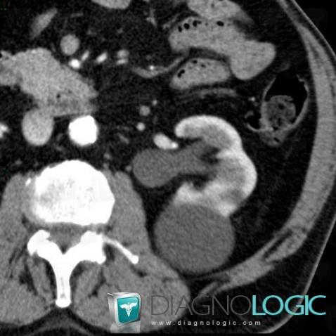 Cyst, Kidney, CT