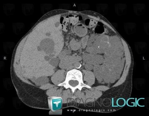 Cyst, Kidney, CT