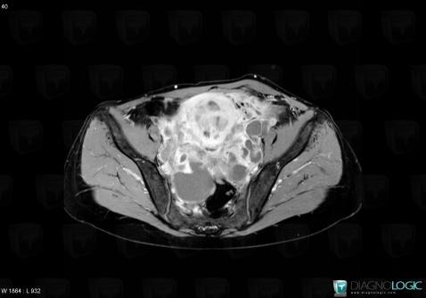 Cystadénocarcinome mucineux, Annexe / Ovaire - trompe, Pelvis / Périnée, IRM