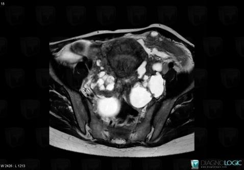 Cystadénocarcinome mucineux, Annexe / Ovaire - trompe, Pelvis / Périnée, IRM