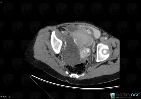 Cystadénocarcinome mucineux, Annexe / Ovaire - trompe, Pelvis / Périnée, Scanner