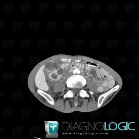 Cystic dystrophy-heterotopic pancreas / Groove pancreatitis, Pancreas, Duodenum, CT