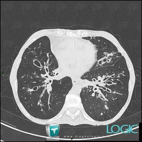 Cystic fibrosis, Airways, CT