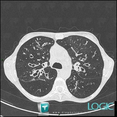 Cystic fibrosis, Airways, CT