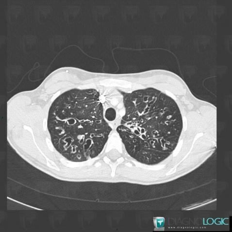 Cystic fibrosis, Airways, CT