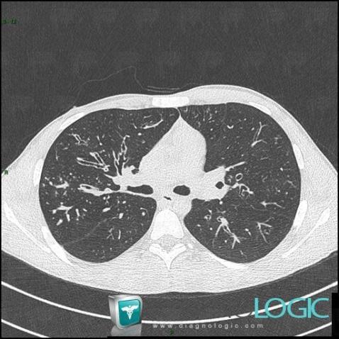 Cystic fibrosis, Airways, CT