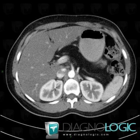 Cystic fibrosis, Pancreas, CT