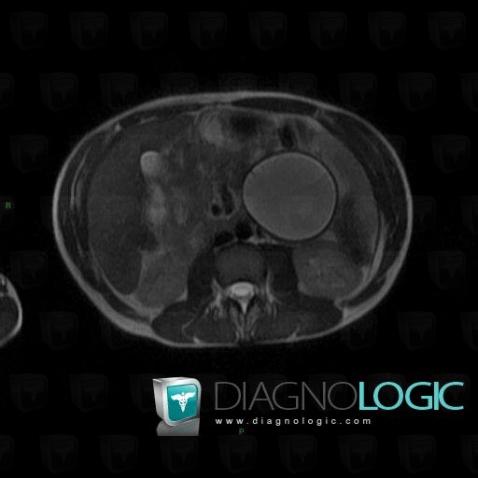 Cystic fibrosis, Pancreas, MRI