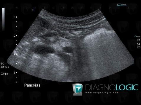 Cystic fibrosis, Pancreas, US
