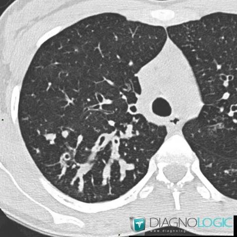 Cystic fibrosis, Pulmonary parenchyma, Airways, CT