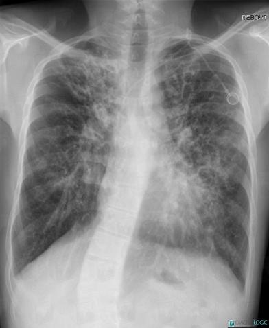 Radiology case : Cystic fibrosis (X rays ,CT) - Diagnologic