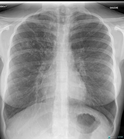 Cystic fibrosis, Pulmonary parenchyma, Airways, X rays