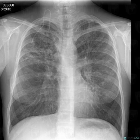 Radiology Case : Cystic Fibrosis (ct ,x Rays) - Diagnologic