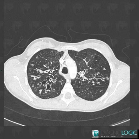 Cystic fibrosis, Pulmonary parenchyma, CT