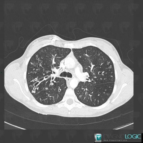 Cystic fibrosis, Pulmonary parenchyma, CT