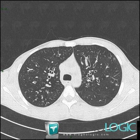 Cystic fibrosis, Pulmonary parenchyma, CT