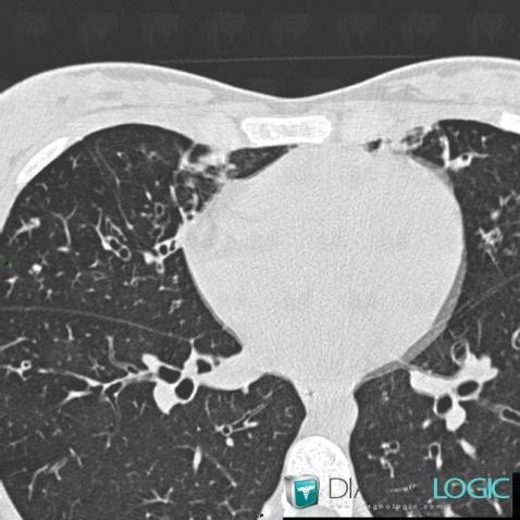 Cystic fibrosis, Pulmonary parenchyma, CT