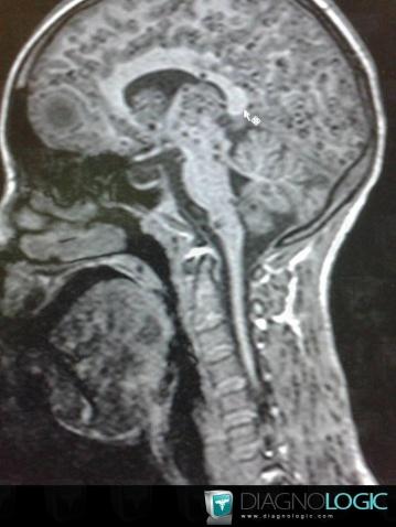 Cysticercosis, Cerebellar hemisphere, Posterior fossa, MRI