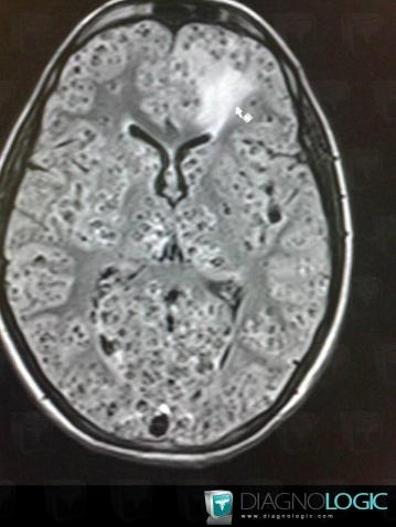 Cysticercosis, Cerebral hemispheres, MRI