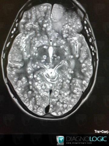 Cysticercosis, Cerebral hemispheres, Ventricles / Periventricular region, MRI